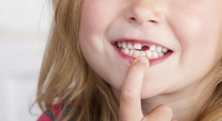 Czym grozi utrata zęba? Co zrobić, gdy stracisz ząb?
