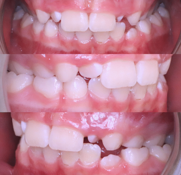 Przed leczeniem, fot. Mama Ortodonta